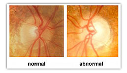 Glaucoma Illustration